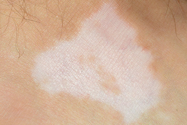 Psoriasis White Patches: What Happens to Your Skin During a Flare-Up?
